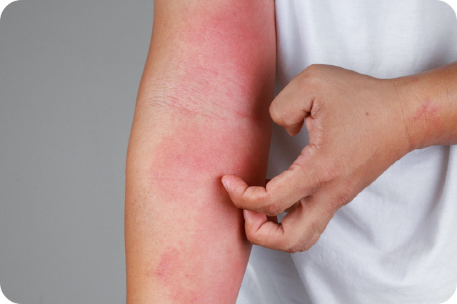 대상포진 백신 접종 후 주사 부위 발적 및 가려움 부작용 예시