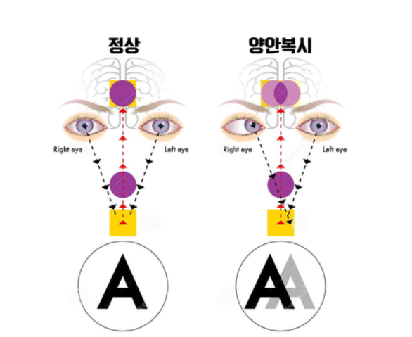 양한 복시 증상과 교정 방법