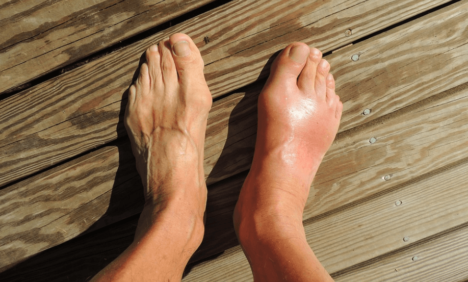 요산 수치 낮추는 법을 확인하고 있는 발에 통풍이 온 사람