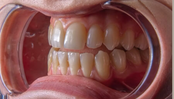 목이 마르고 침을 자주 삼키는 증상, 원인과 해결 방법3