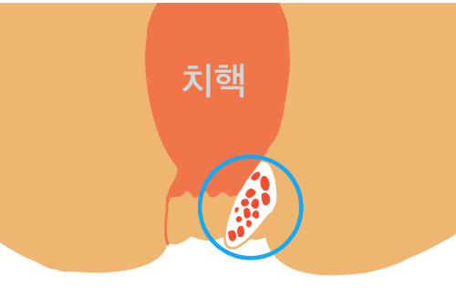 치핵 사진