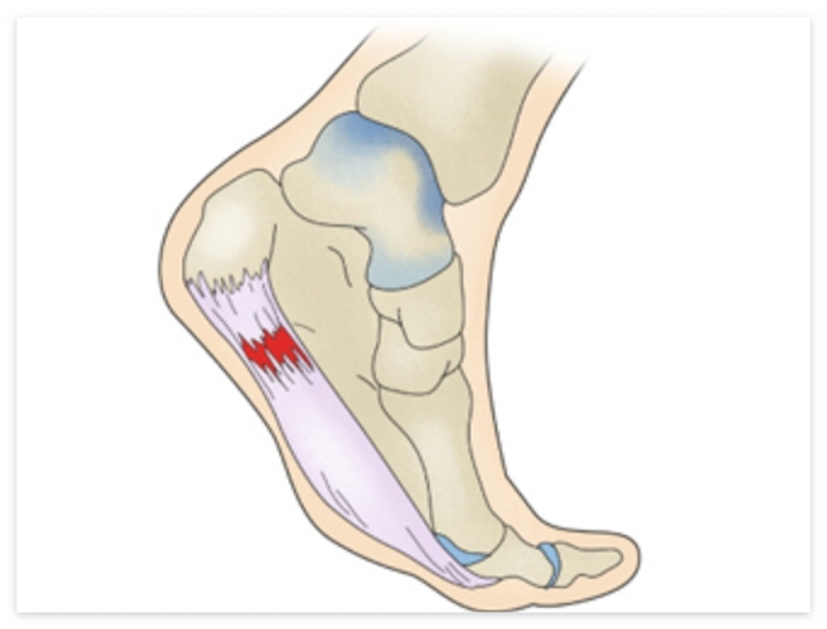 족저 근막염 자가치료