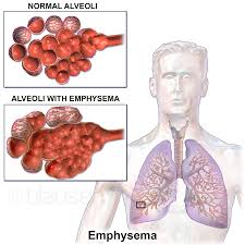 만성 폐쇄성 폐질환