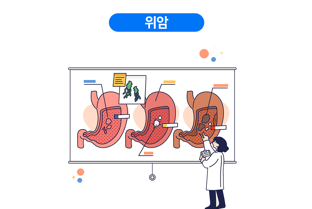 위암 초기증상