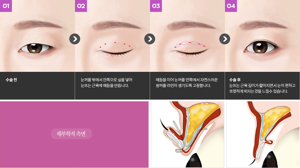 여자 무쌍 눈매 교정