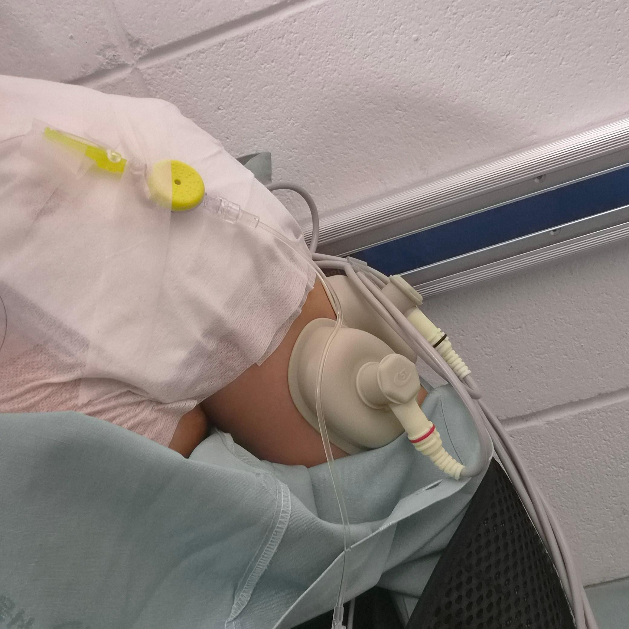 어깨 와순파열 봉합수술 후 mri사진 물리치료 기록