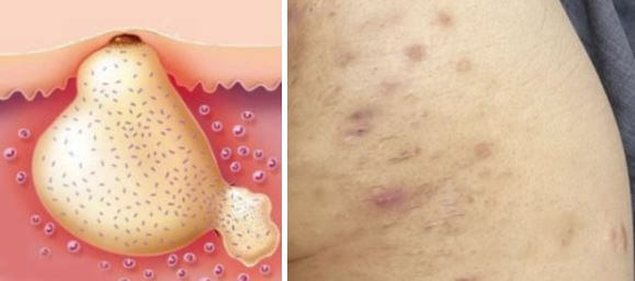 화농성 한선염 원인