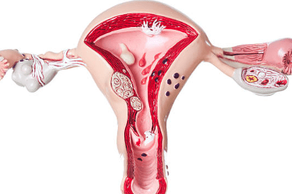 자궁근종 증상 7가지, 수술후 회복기간