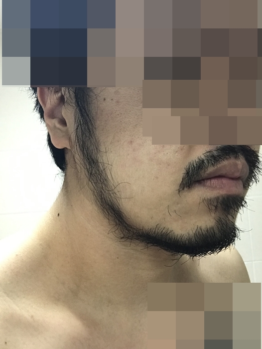 미녹시딜 6개월 사용 후 친커튼 수염 라인이 자리 잡은 모습, 턱선과 턱밑 수염 밀도 변화 관찰
