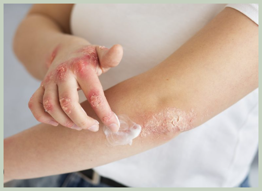 피부묘기증 개선 방법