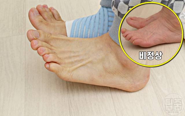 허리디스크 증상 자가진단 까치발