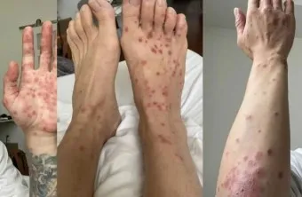 엠폭스 증상 예방접종 대처법 치료방법_2