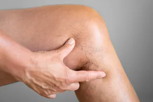 하지-정맥류-수술비용