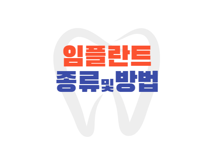 임플란트 종류 6가지 임플란트 방법 임플란트 가격비교 방법