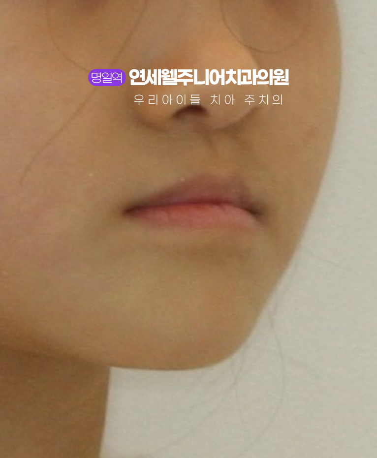 초등학생 주걱턱교정 전 아래턱이 앞으로 발달한 아이 정면 모습