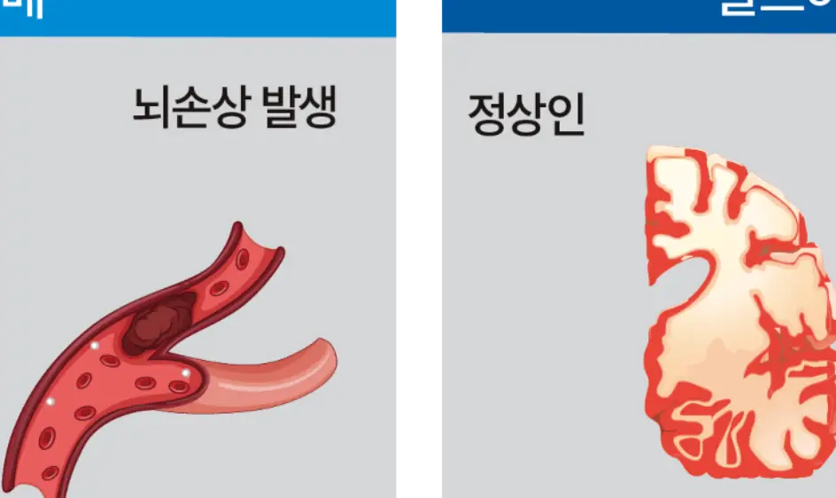 치매 초기증상