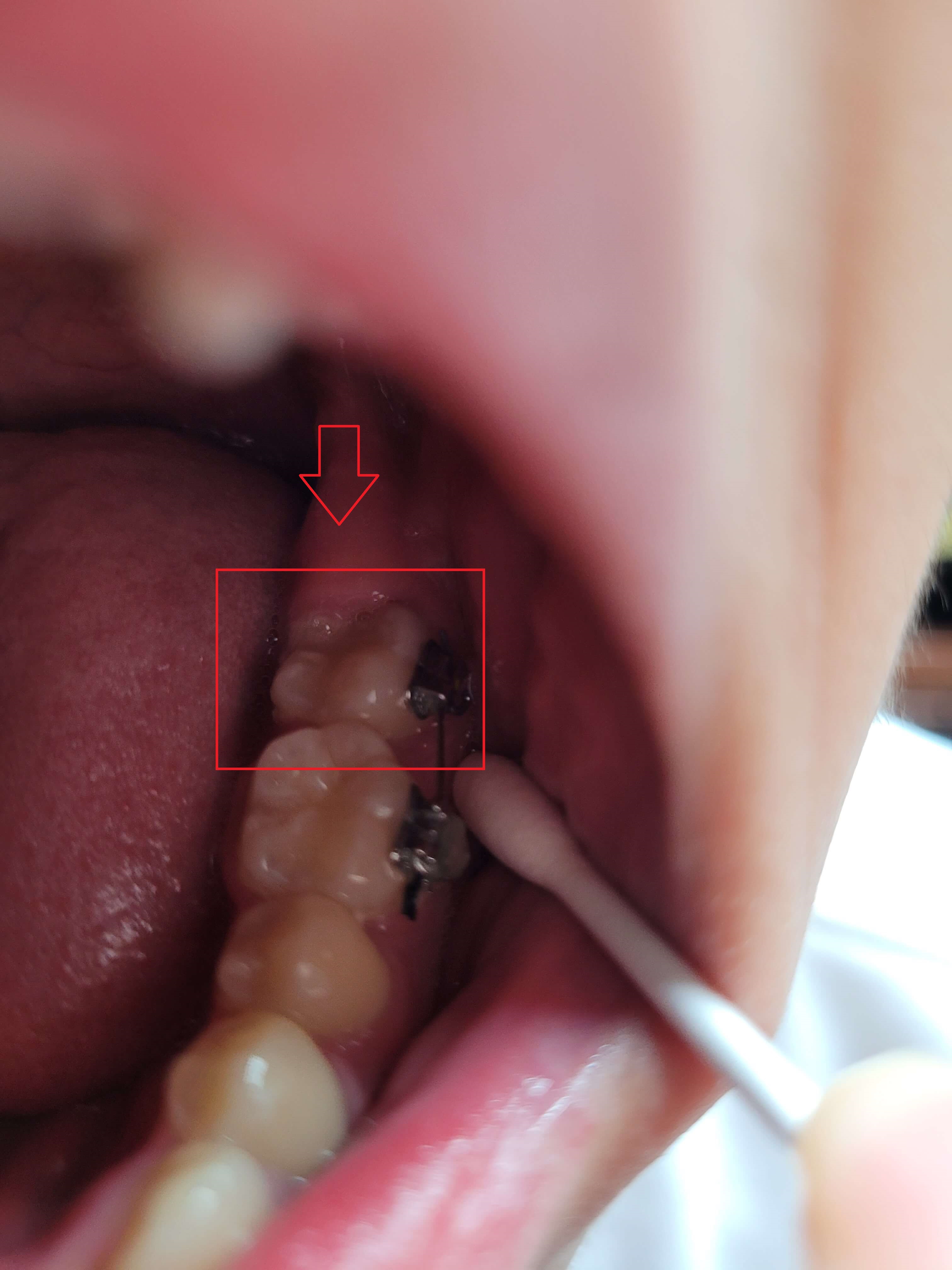 부정교합 가위교합 과개교합 치아교정 후기11