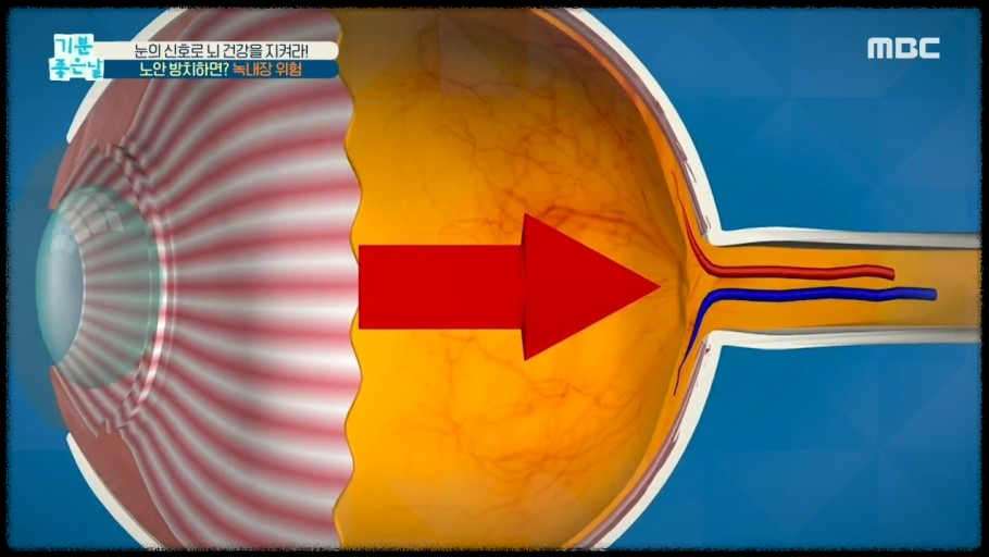 눈 건강&amp;#44; 조기 진단의 열쇠