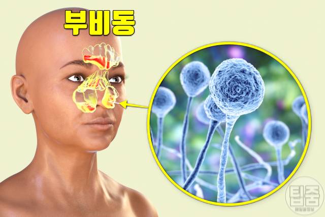 눈이 붓는 이유 눈 붓기가 안빠져요 눈붓기 원인 알러지 비염