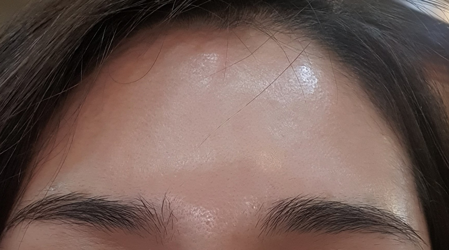 이마보톡스 후기