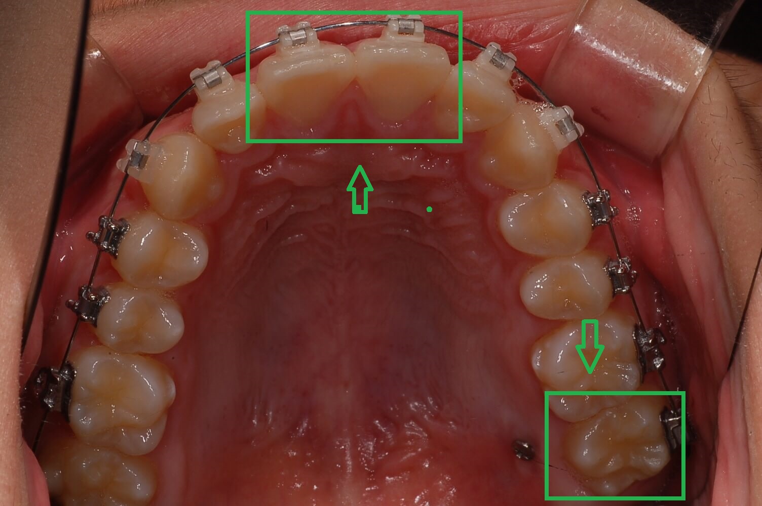 부정교합 가위교합 과개교합 치아교정 후기19