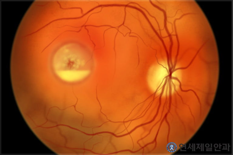 실명을 부르는 4대 망막질환 – 황반변성, 당뇨망막병증, 망막박리, 망막혈관폐쇄 총정리 관련 사진