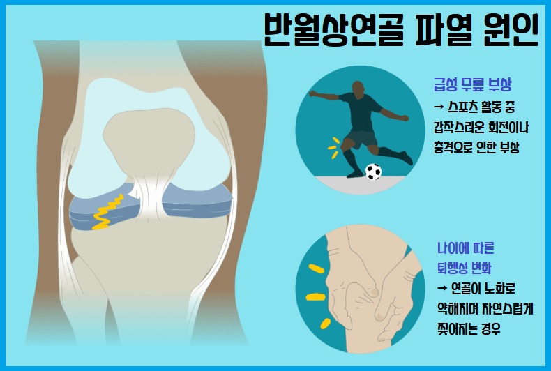 반월상 연골 파열 원인