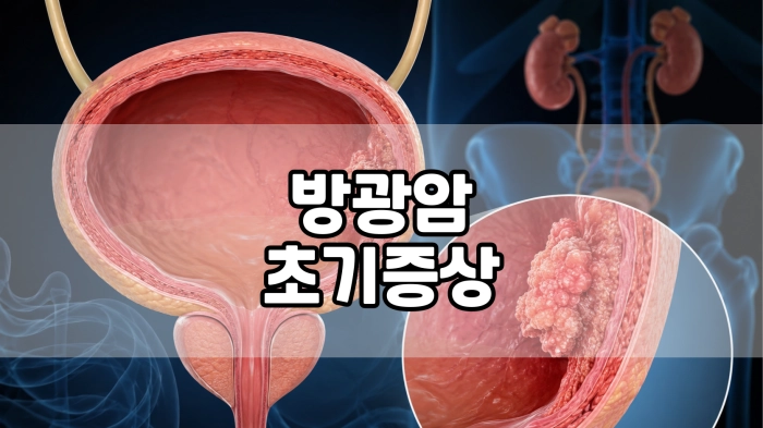 방광암 초기증상