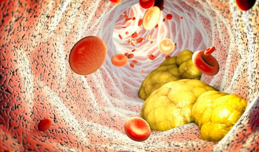 고지혈증약 부작용