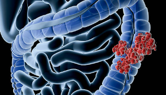 게실염 증상 치료 방법 게실염에 좋은 음식 원인 수술 종류 대장 게실염 재발 가능성