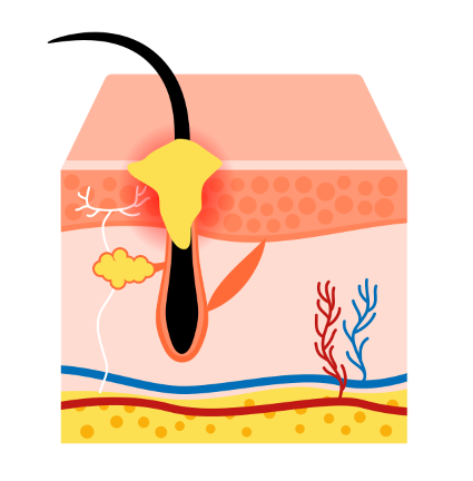 모낭염 원인과 치료방법