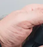 녹내장 초기 증상 &mdash; 시야를 서서히 빼앗는 침묵의 질환