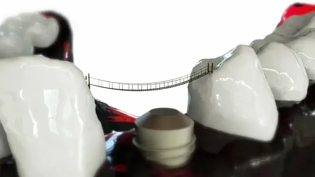 임플란트 수명