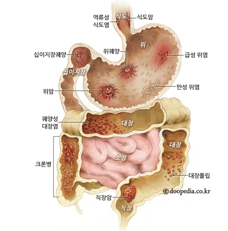 소화기관 및 대장암 발생부위 설명 그림