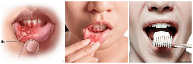 구내염 관련 사진 3개
