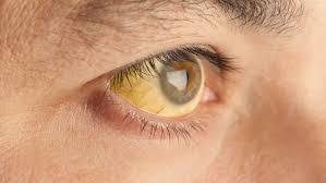 췌장암 의심 증상 여섯가지 발생원인 초기 의심 증상 검사방법 예방법