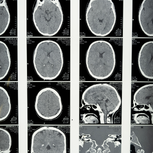 교모세포종의-증상과-치료법