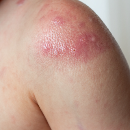 두드러기의 종류