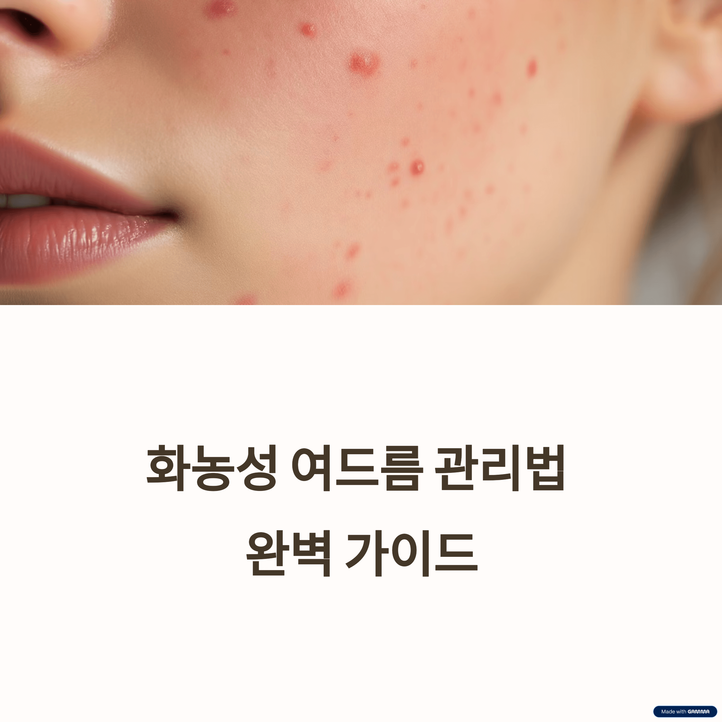 화농성 여드름 관리법 완벽 가이드: 원인부터 효과적 관리법&middot;전문의 상담 시기까지