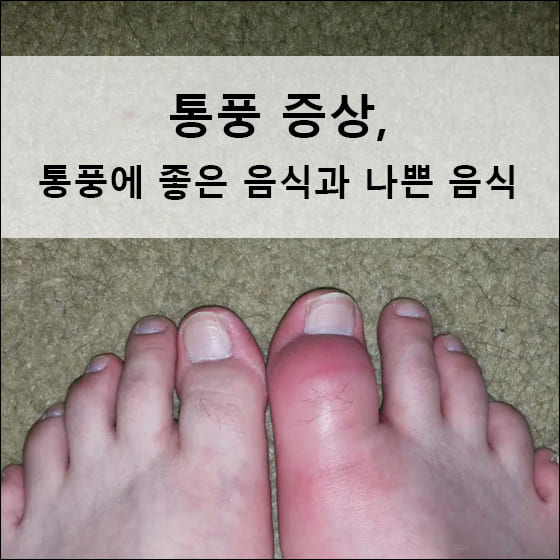오른쪽 엄지발가락이 부푼 모습