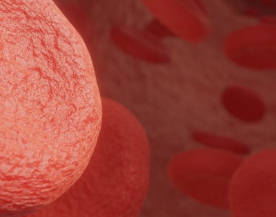 관상동맥 석회화 증상