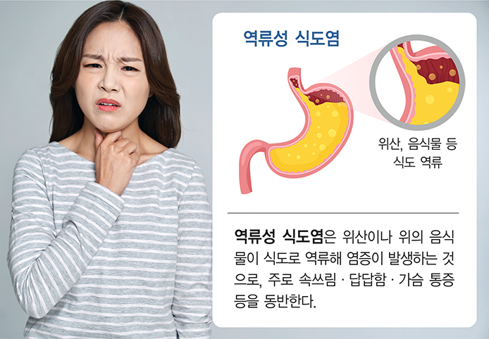 역류성 식도염 재발 이유&amp;#44; 약을 먹어도 계속 불편한 진짜 원인