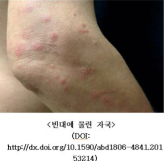 빈대공포_확산
