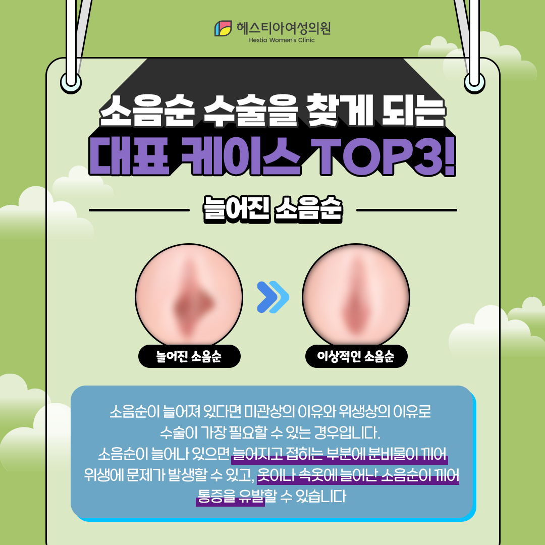 늘어진 소음순