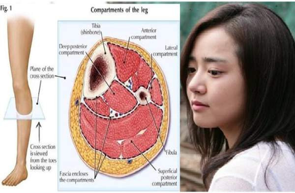 급성구획증후군 원인 증상 치료법, 문근영 유퀴즈 복귀로 보는 골든타임 사수하기
