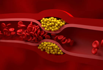 고지혈증 증상, 고지혈증에 좋은 음식, 고지혈증 수치 총정리 (2024ver)