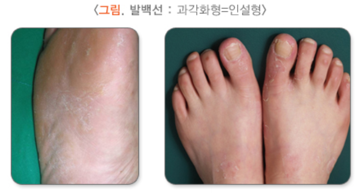 과각화형 무좀