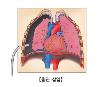기흉 증상·원인·치료 - 갑자기 숨쉬기 힘들다면