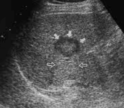 2~3cm hcc sono features