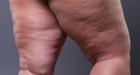 셀룰라이트 없애는 법